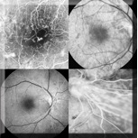 Fluorescein Angiography 