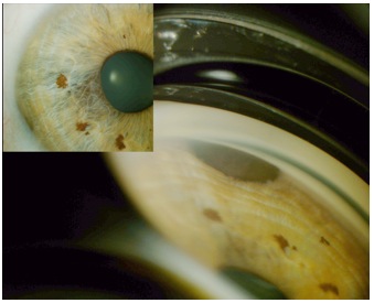 Slit Lamp/Gonioscopic Imaging | Department Of Ophthalmology